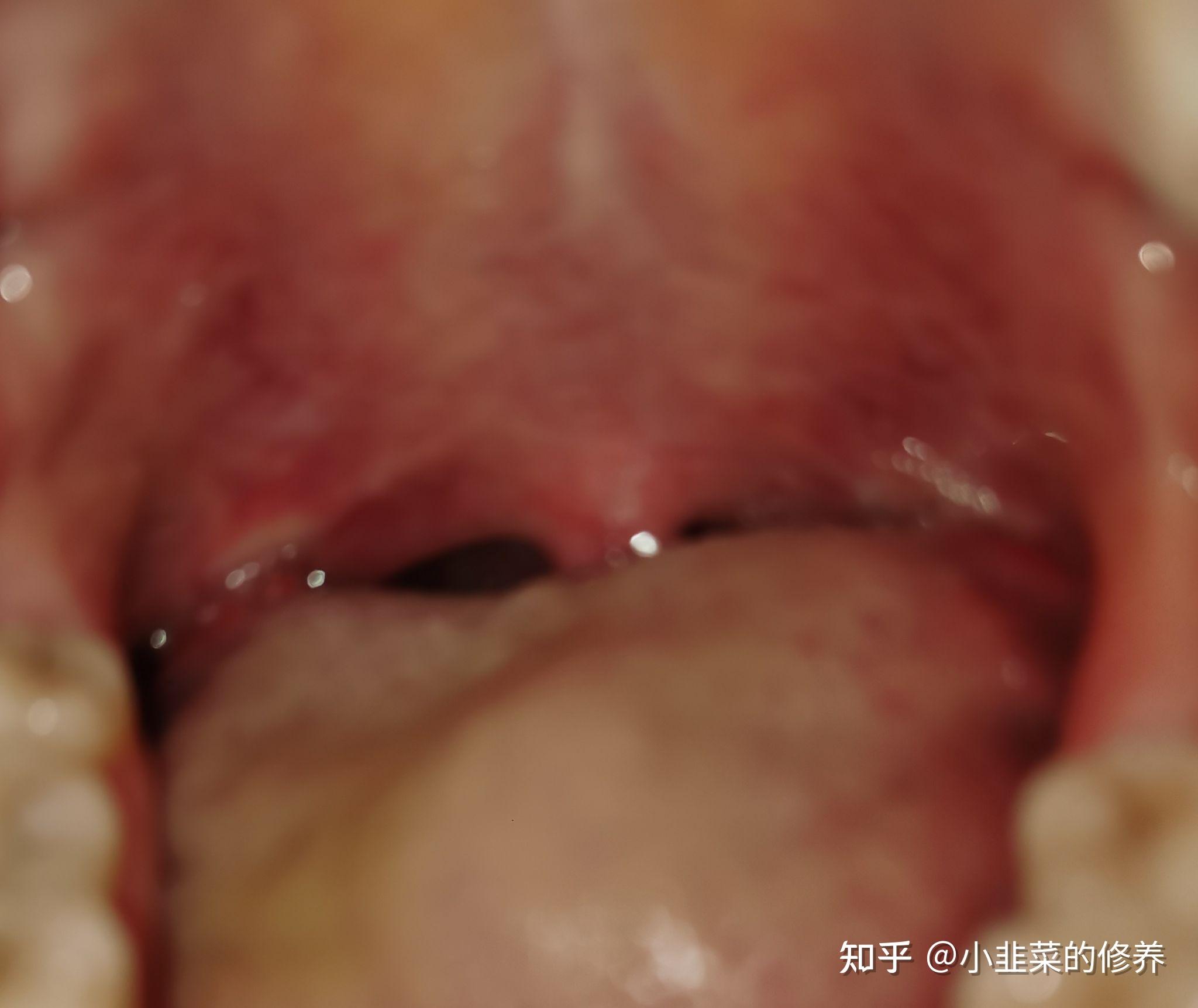 慢性扁桃体炎,多年的老扁桃终于割了!持续更新!