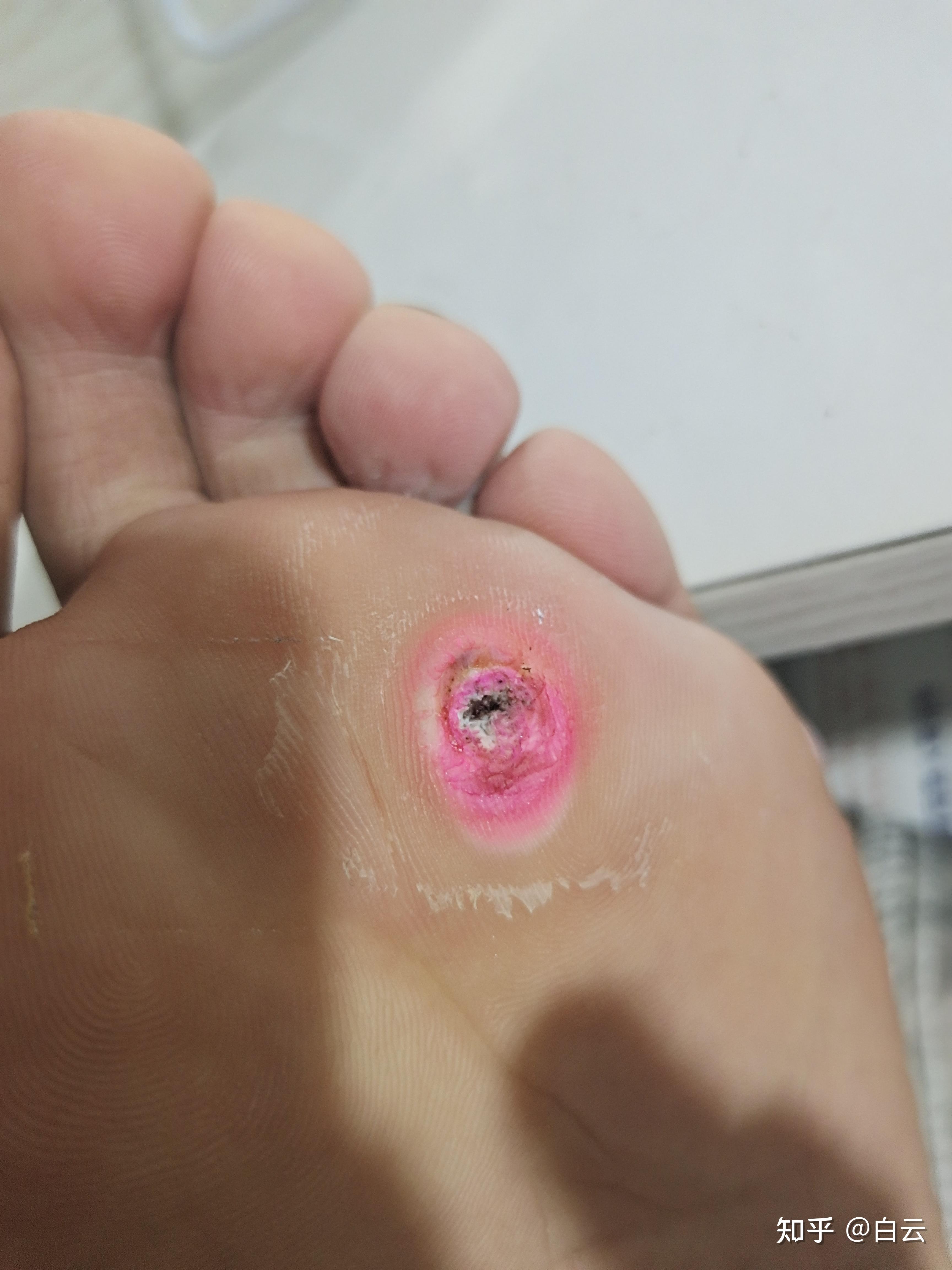 鸡眼的治愈全过程