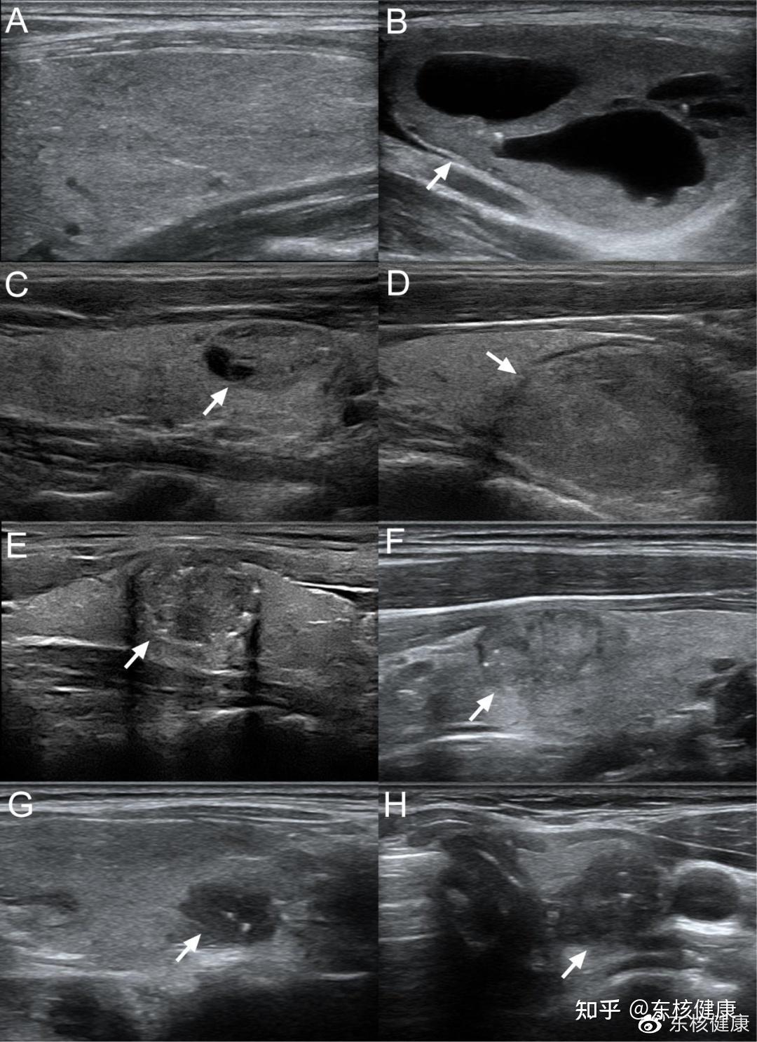甲状腺结节超声图像图片