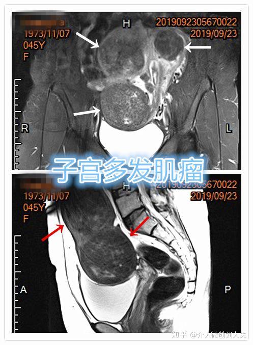 子宫肌瘤与介入栓塞的那些事 知乎