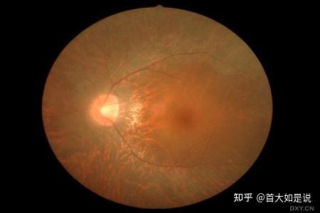 首大聂红平:什么是视网膜色素变性 有哪些特殊表现