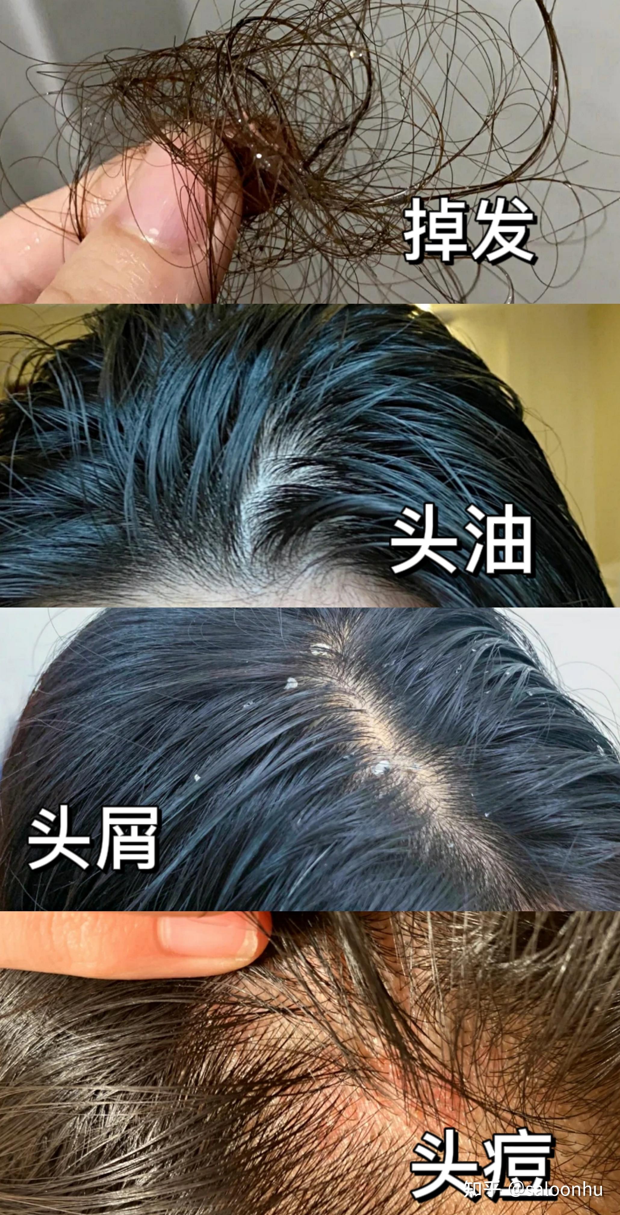 掉发,头痒,头屑,头油,头痘这些问题都是因为你头上有螨虫,健康的头皮