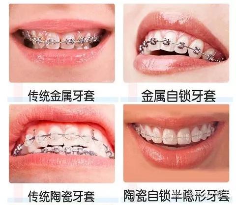 隐形矫正常见问题矫正效果如何
