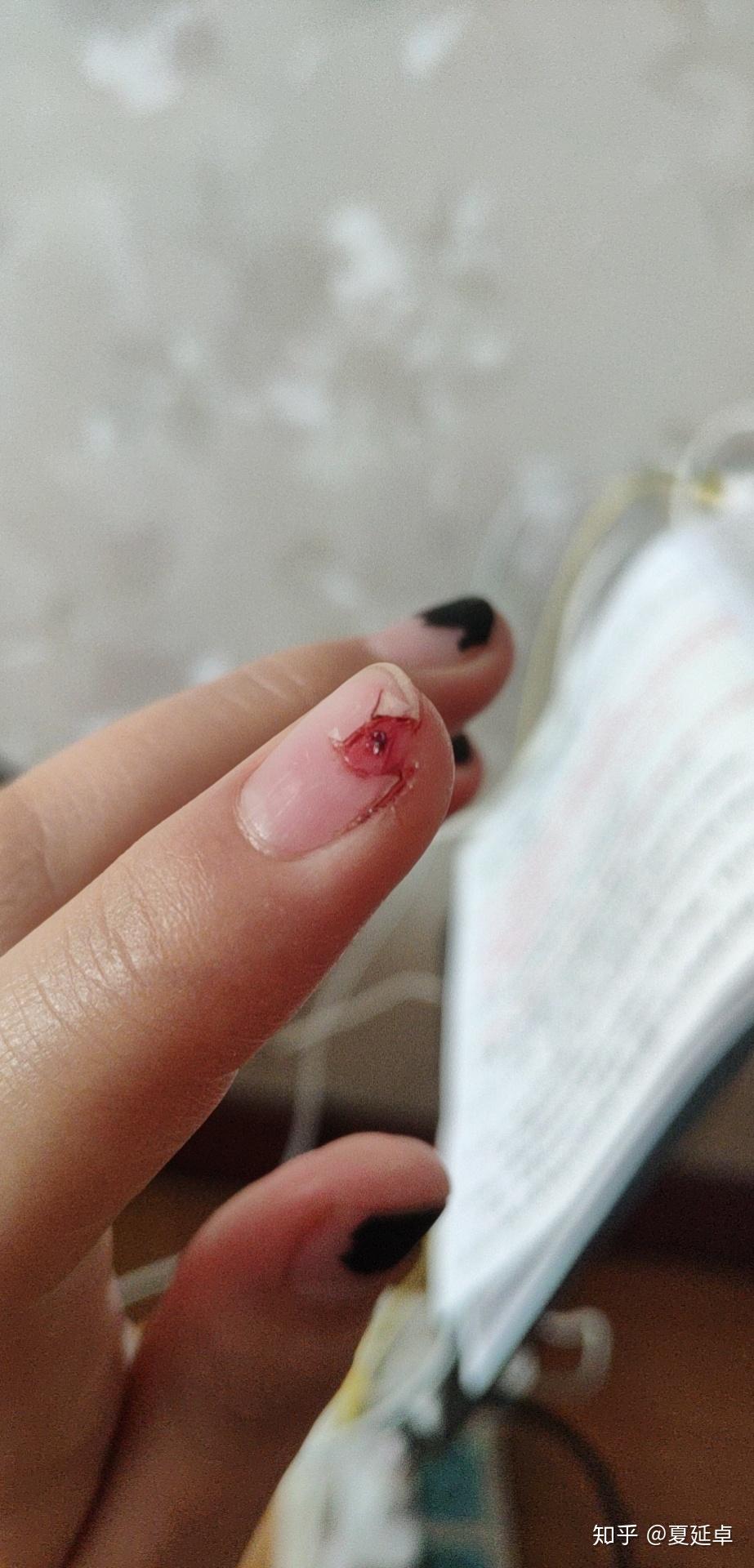 切菜时指教被切掉了掉落的指甲盖可以安上再包扎吗