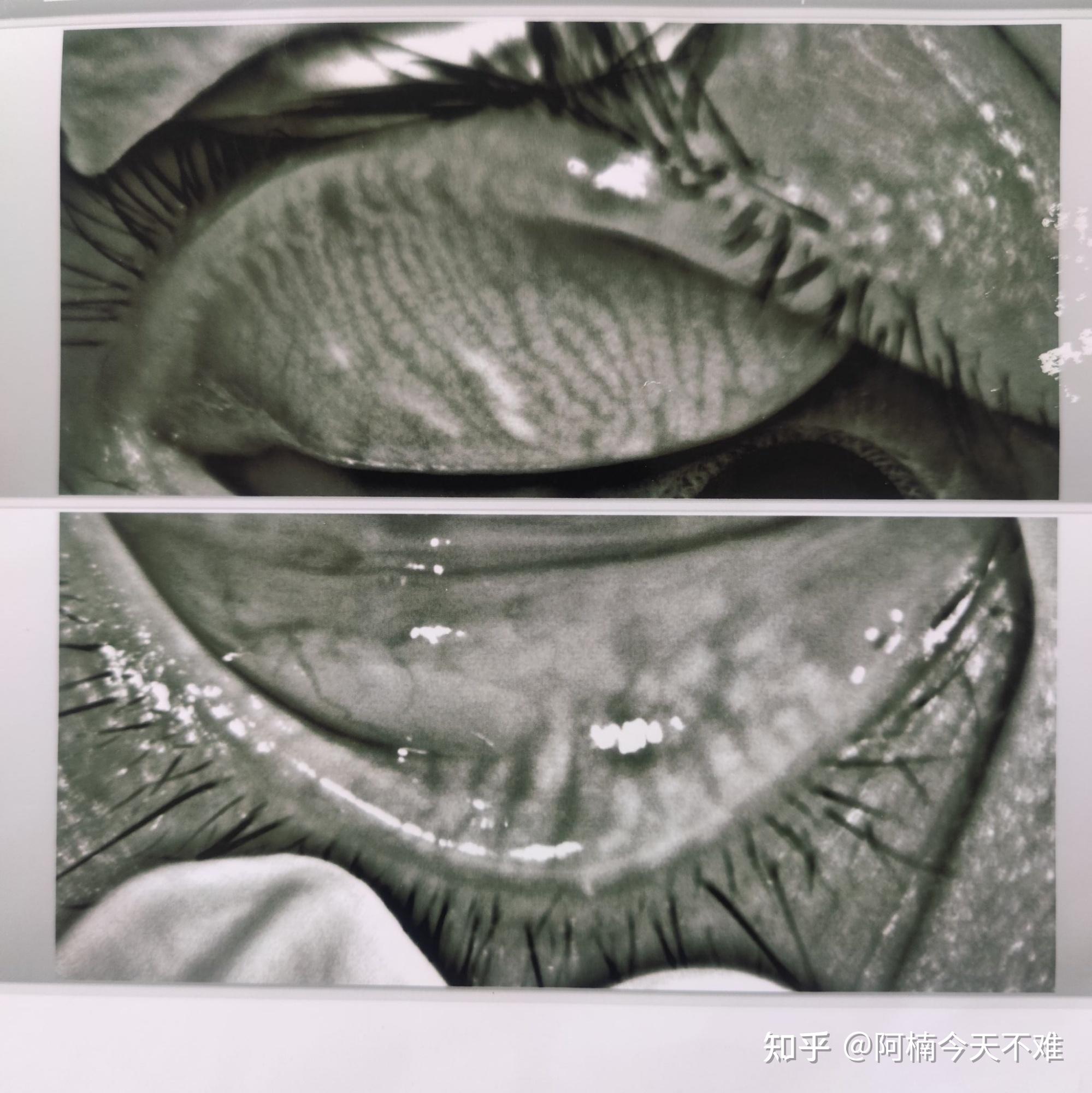 8再度爆发为中重度第一次做的检查没有拍睑板腺2020.11.