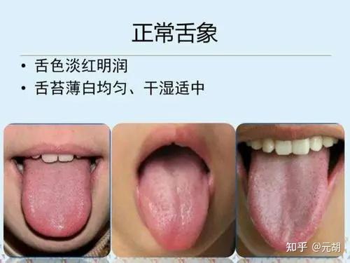 了解中医望舌 带你了解正常舌象! - 知乎
