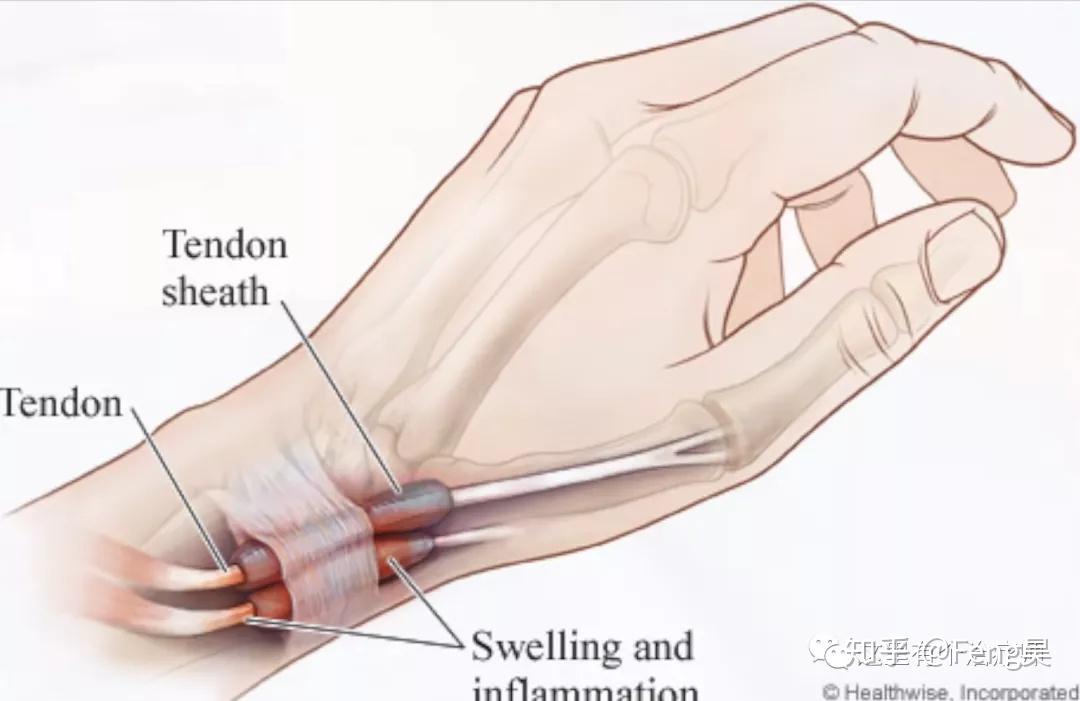 運動損傷respond第三期媽媽手橈骨莖突狹窄性腱鞘炎