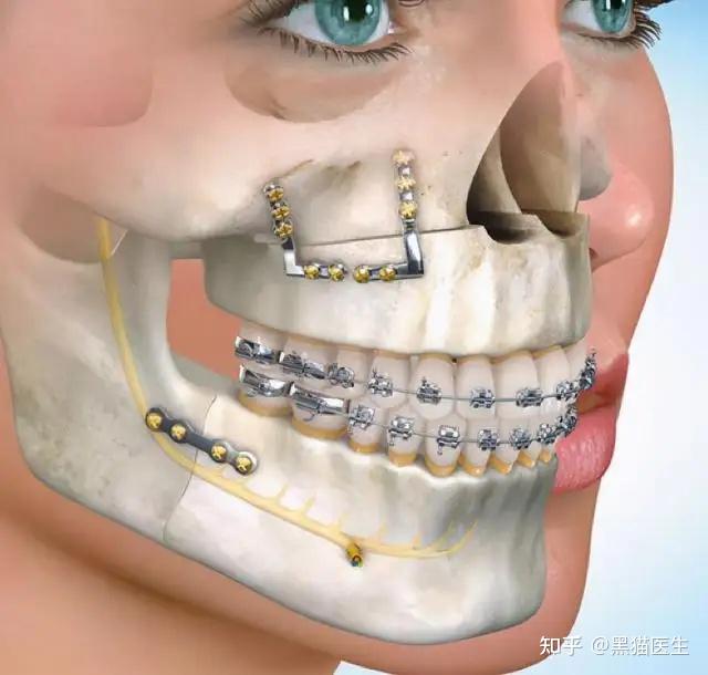 关于下颌后缩的那些事