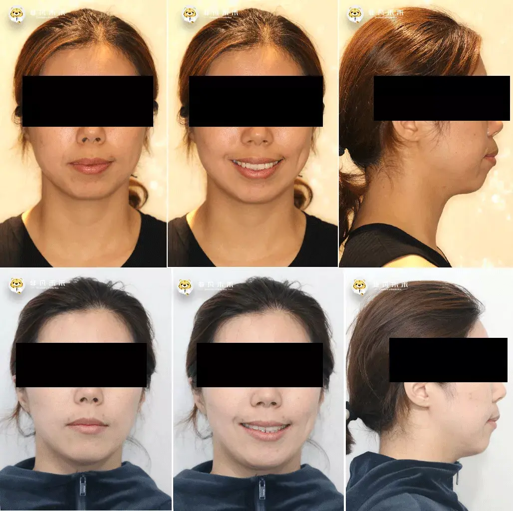 正畸病例改善前突面型病例1例