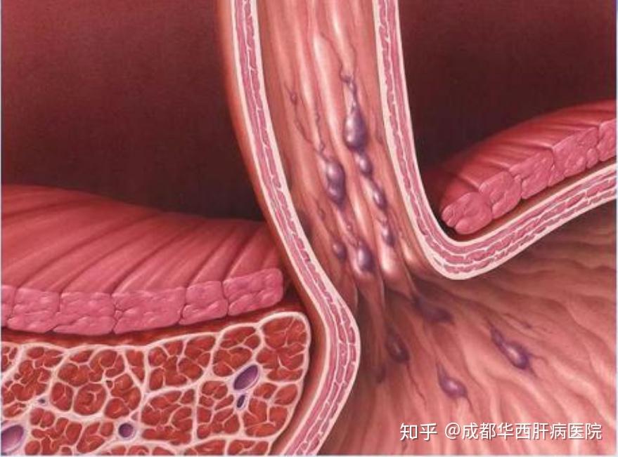 知乎热门话题:胃出血静脉曲张是一种什么样的病? - 知乎
