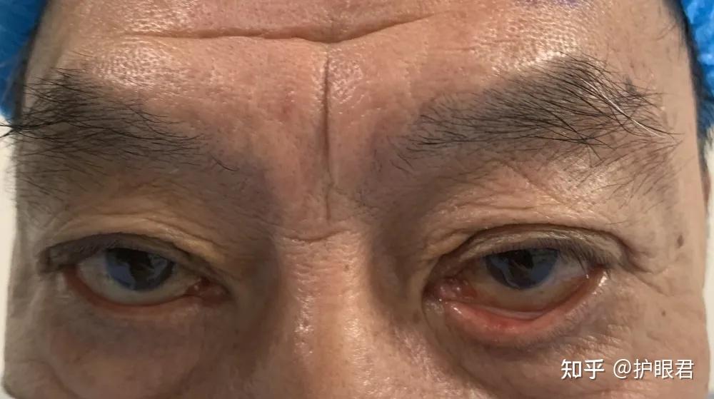 一般认为是由于老年人眼轮闸肌功能减弱,眼睑皮肤及外眦韧带松弛导致