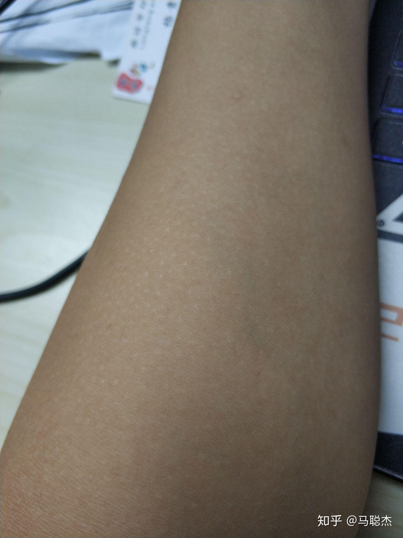 皮肤长凸点，像鸡皮(皮肤上有凸起的小疙瘩跟鸡皮很像)