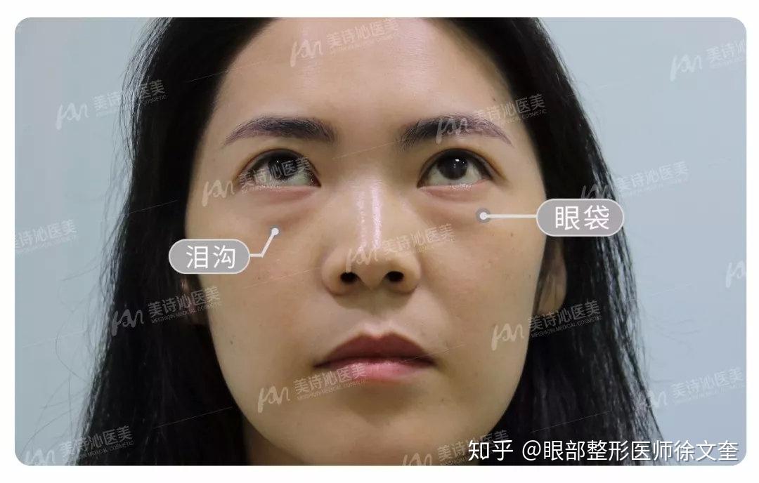去掉泪沟轻松年轻10岁教你彻底去除泪沟