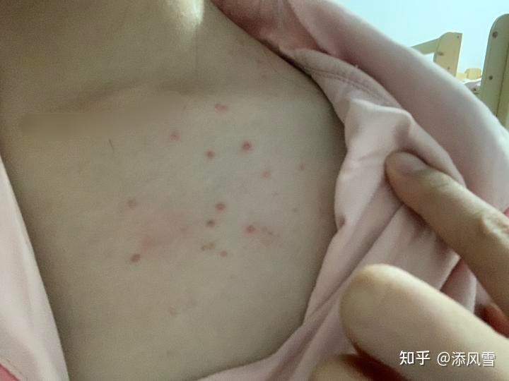 马拉色菌毛囊炎该怎么治疗