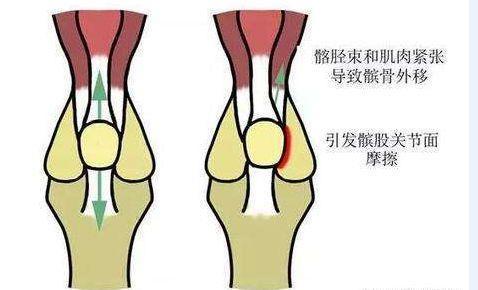 2,患者麦氏征试验,轴移试验,研磨试验均无问题,可以排除半月板磨损而