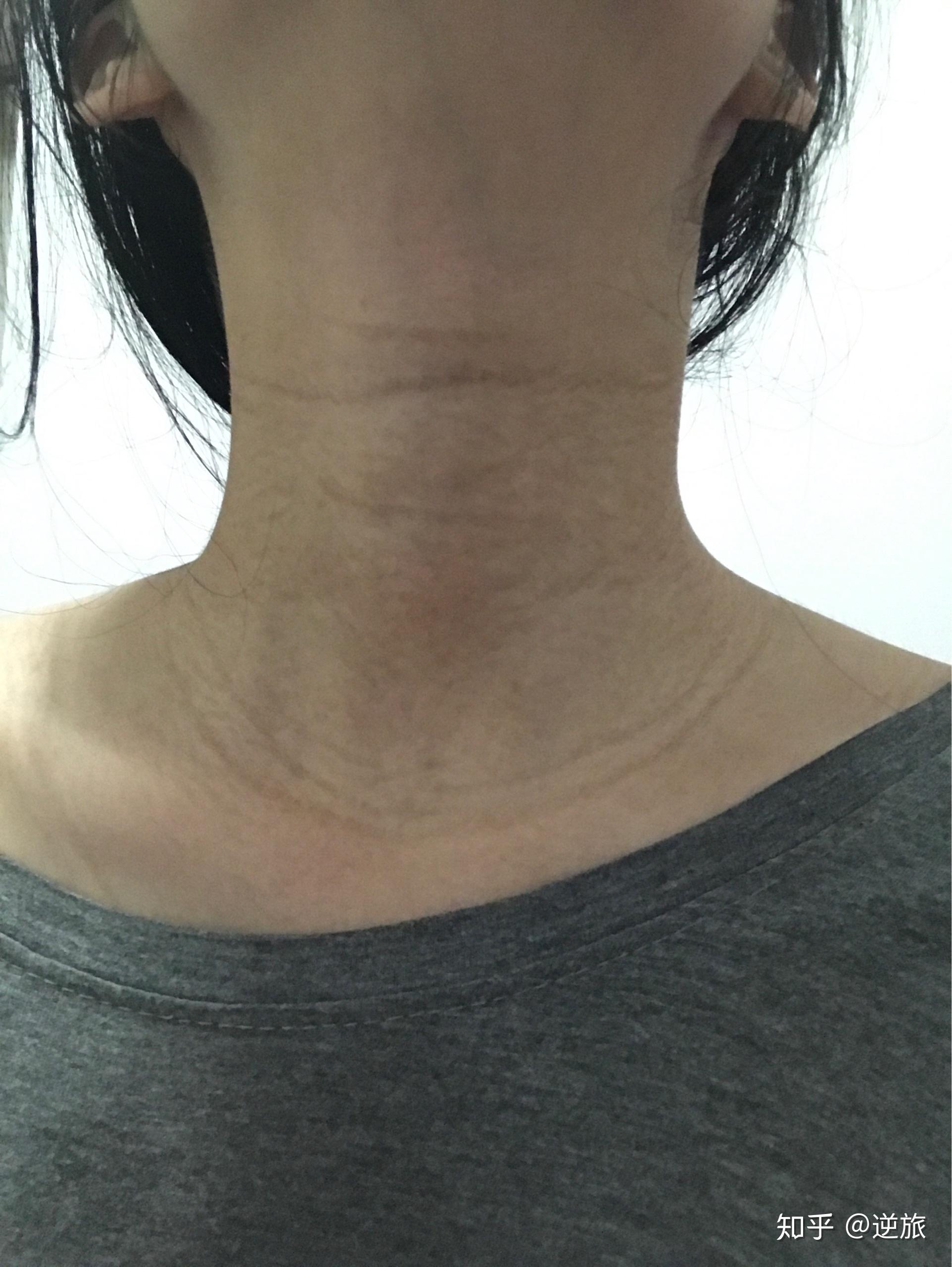 脖子上出现这样的纹路可千万要注意_颈部_颈椎_皮肤