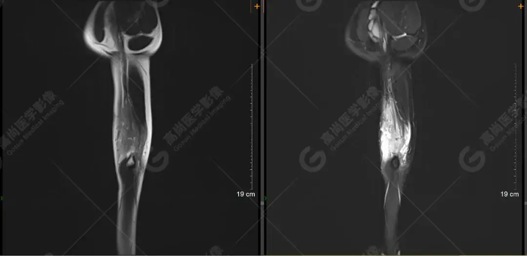 1月余"来我院就诊,查体发现左肘关节内侧皮肤呈多发斑点状暗褐色斑,无