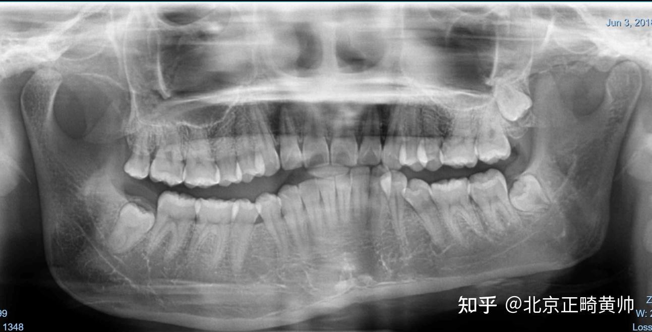 案例分享|成人骨性+牙性脸歪大小脸+重度锁颌,牙齿矫正重点分析 - 知乎