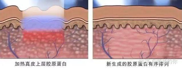 女性肚子上的妊娠紋應該怎麼去除