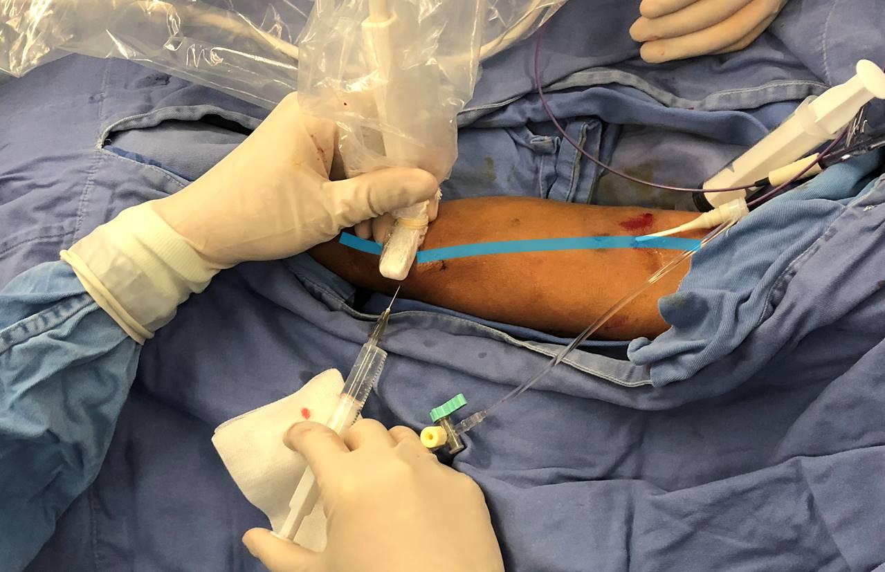 超声引导下摇篮式浸润麻醉在内瘘pta中的应用