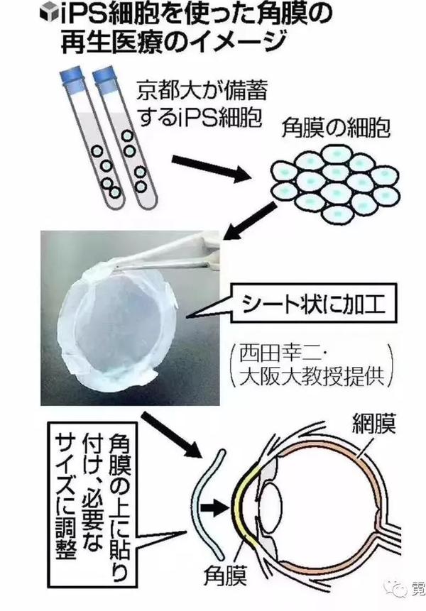 人类壮举 全球首例ips制成眼角膜移植成功 日本医疗 知乎