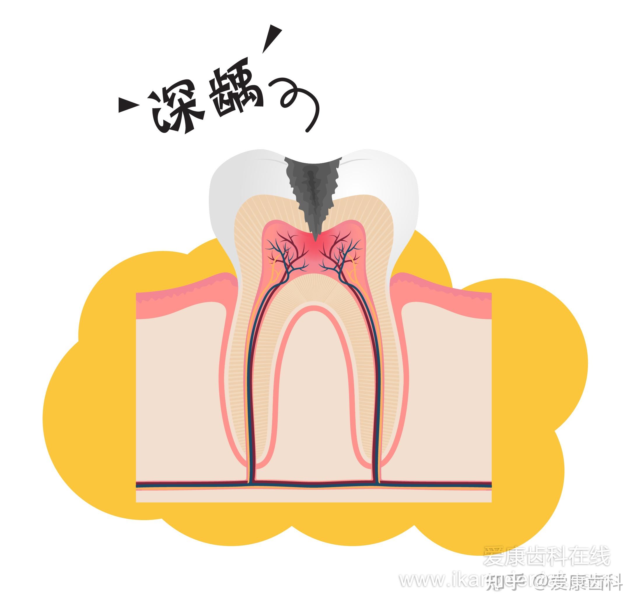 明天要去做根管治疗想知道这是怎么一回事