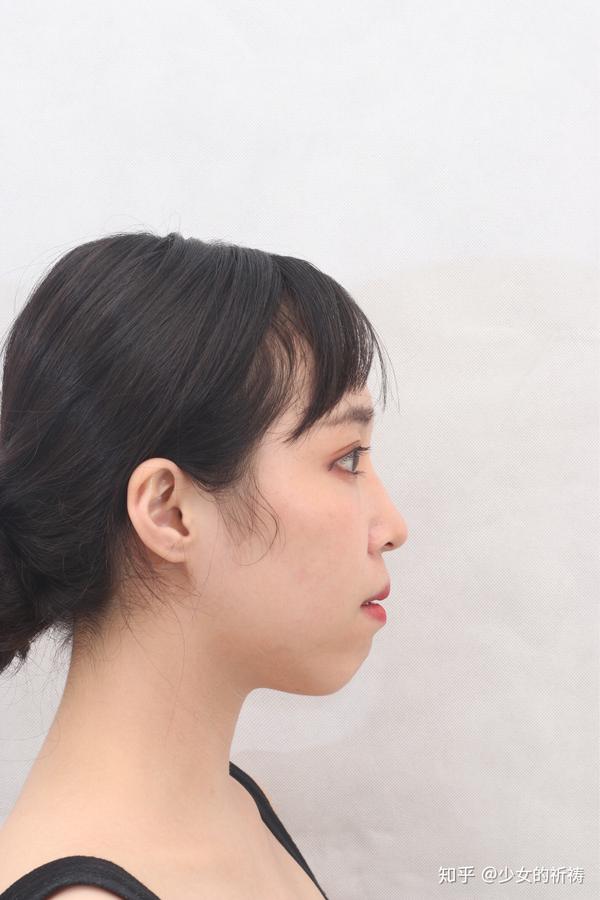 安氏开颌3类,我的正畸之路 - 知乎