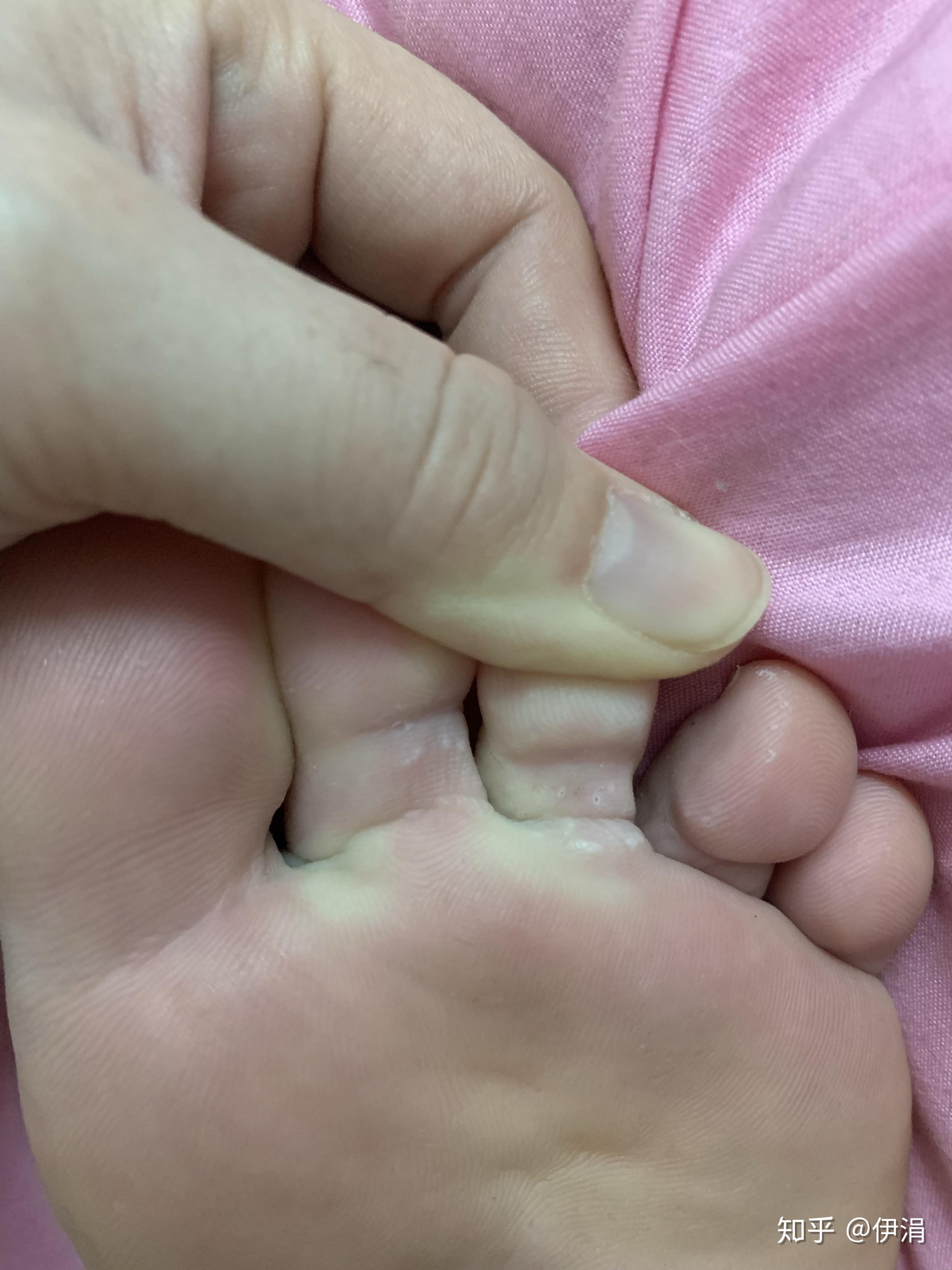 8岁儿童脚趾头脱皮图片