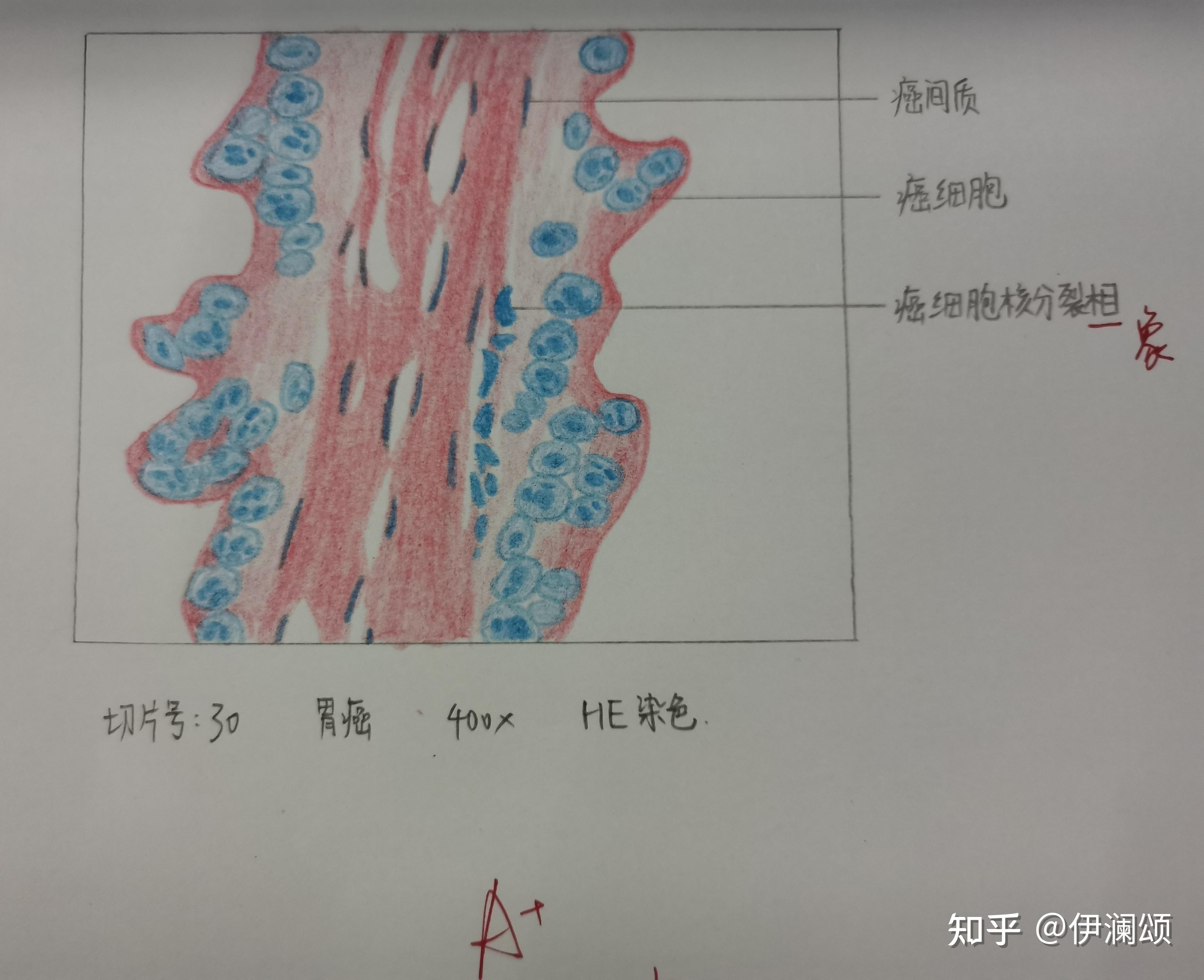 腺淋巴瘤画图图片