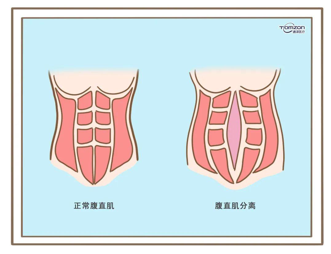 在孕晚期,增大的子宫会将腹肌拉长,使两条腹直肌从腹白线的位置分开