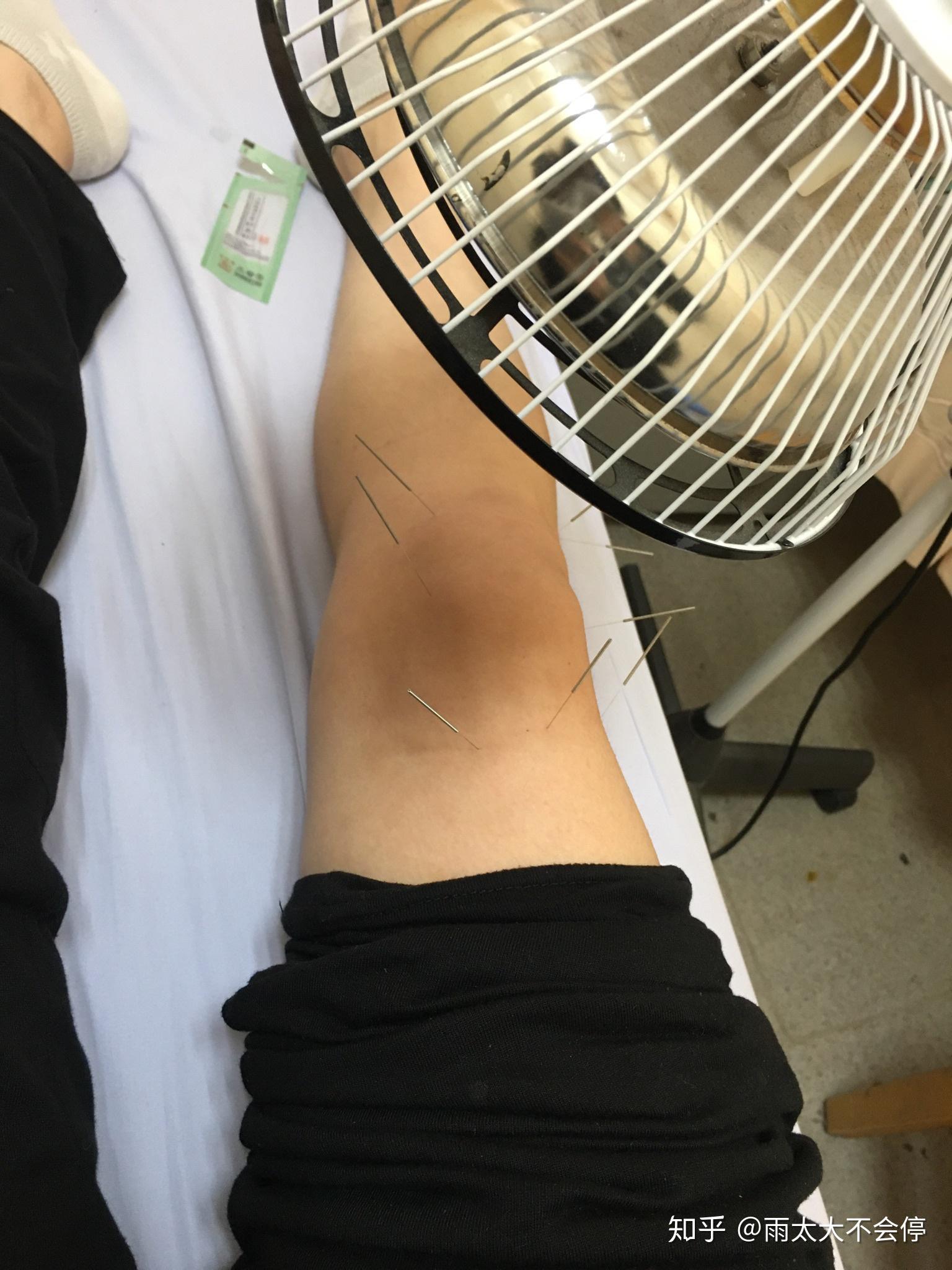 一个90后膝关节劳损髌下积液轻度滑囊炎的始末