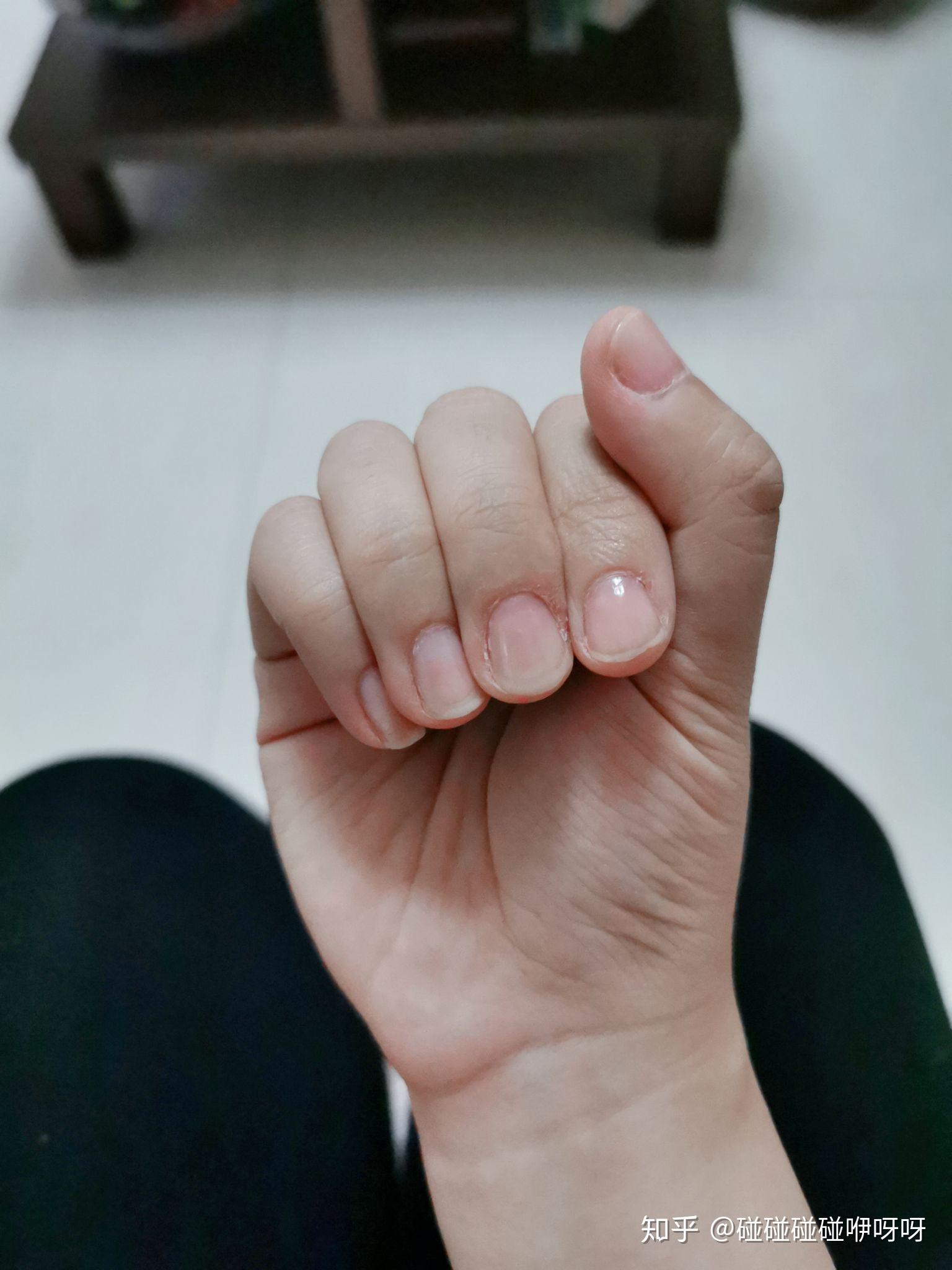 三大灰指甲的症状有哪些-长春华山皮肤病医院