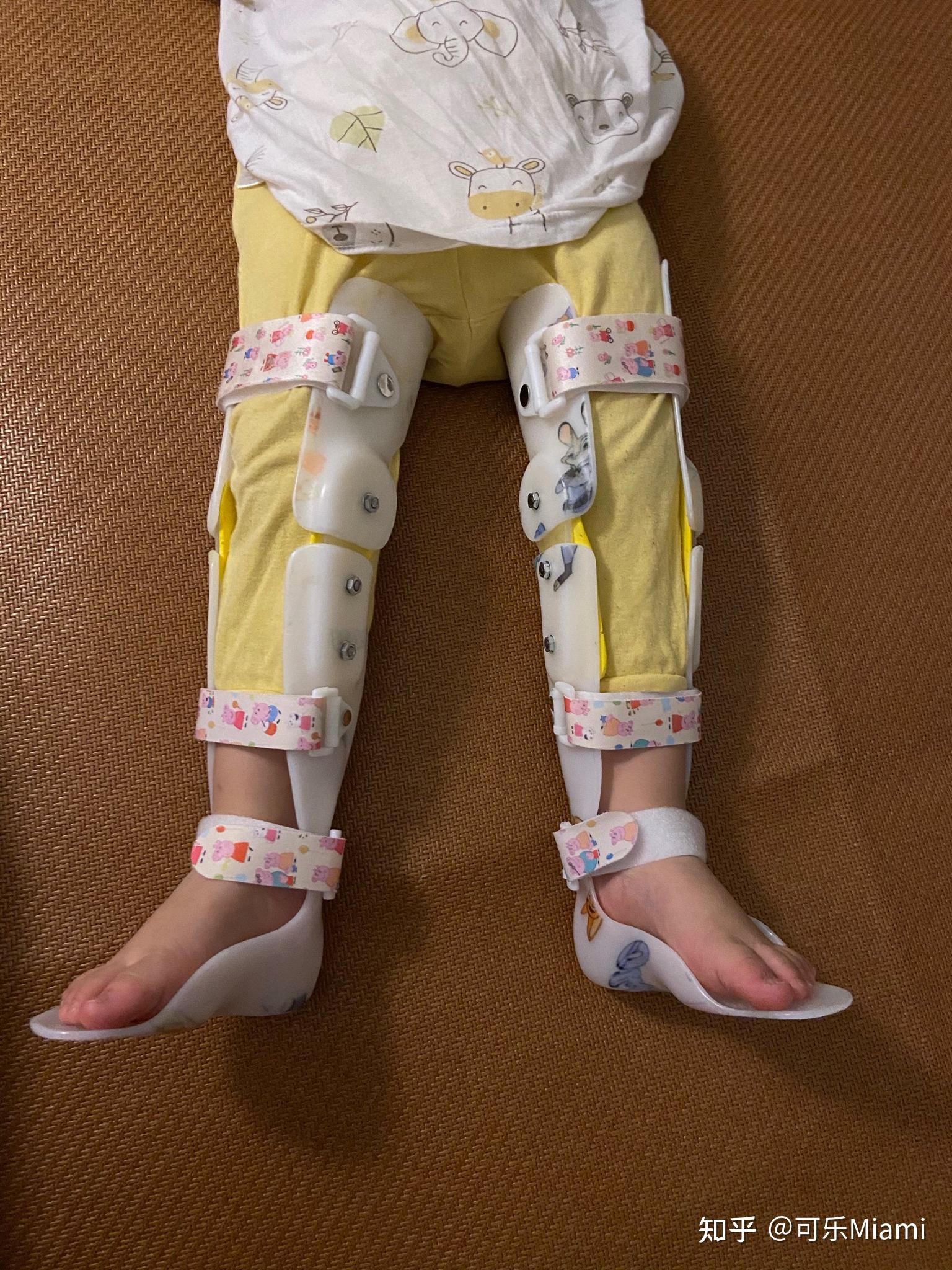 两岁多宝宝x型腿照片图片