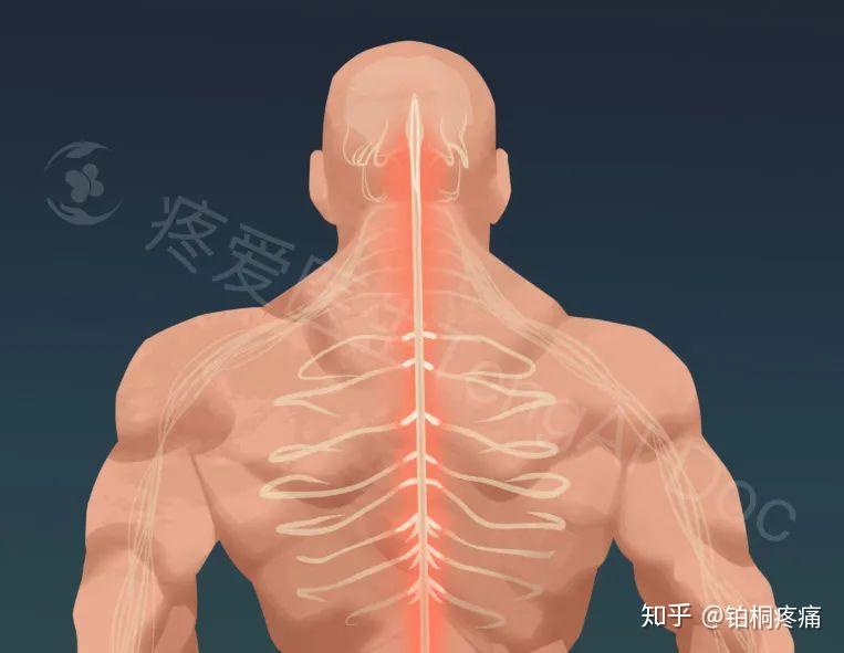 水痘—带状疱疹病毒也钟爱于神经,它会潜伏在你的神经节(脊椎背根神经