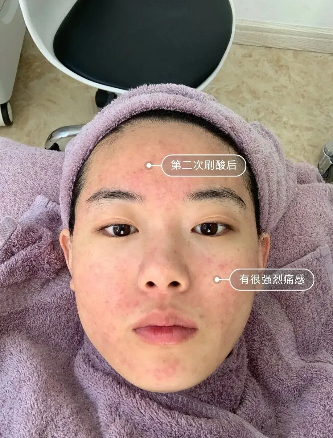 刷酸是烂脸还是换脸?心动前你一定要知道这些.... - 知乎
