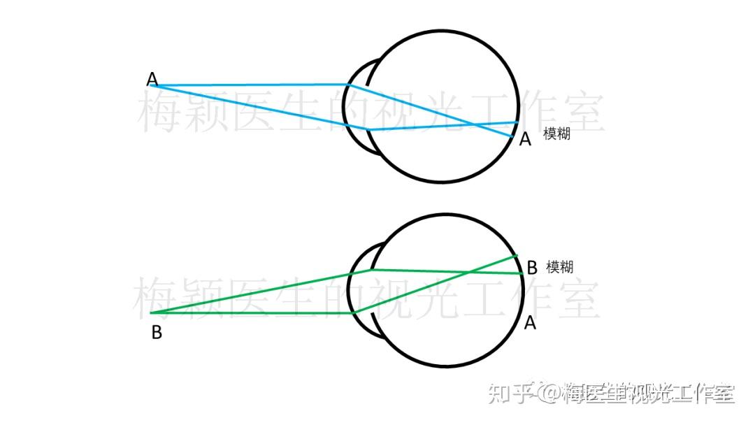 近视眼的视线在视网膜前交叉了那视网膜像是正像