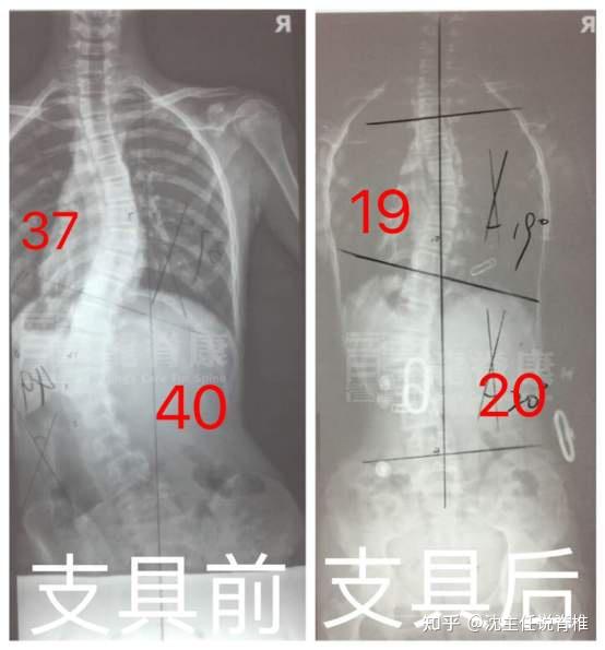 女孩脊柱侧弯40为何在2个月就将体态恢复基本正常
