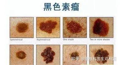 赣州专业祛痣医院 | 痣也可能会癌变!长在这些地方要注意 - 知乎
