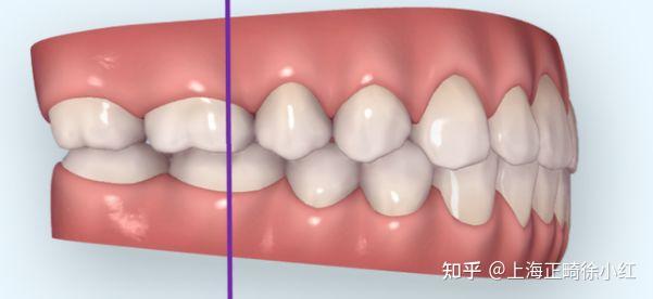 上海牙齿矫正只有一颗牙齿乱可以只矫正这一颗牙吗