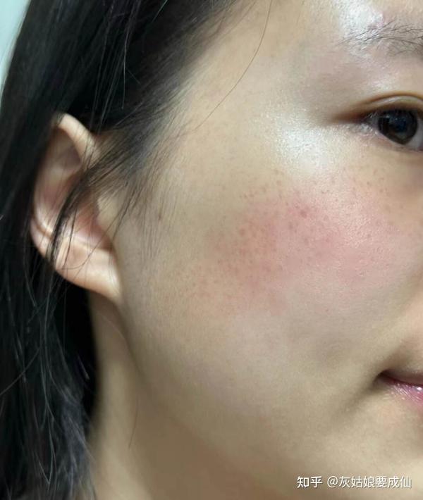 (真人实测开贴)从皮肤科医生的角度,教你实现美白淡斑,这款美白精华统