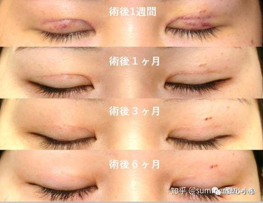 想整得毫无痕迹 这位自然派良心好医生了解一下 日本医美 知乎