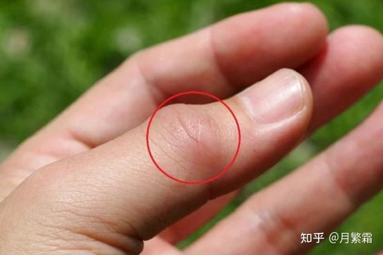 尿酸明明正常了为什么痛风还是反复