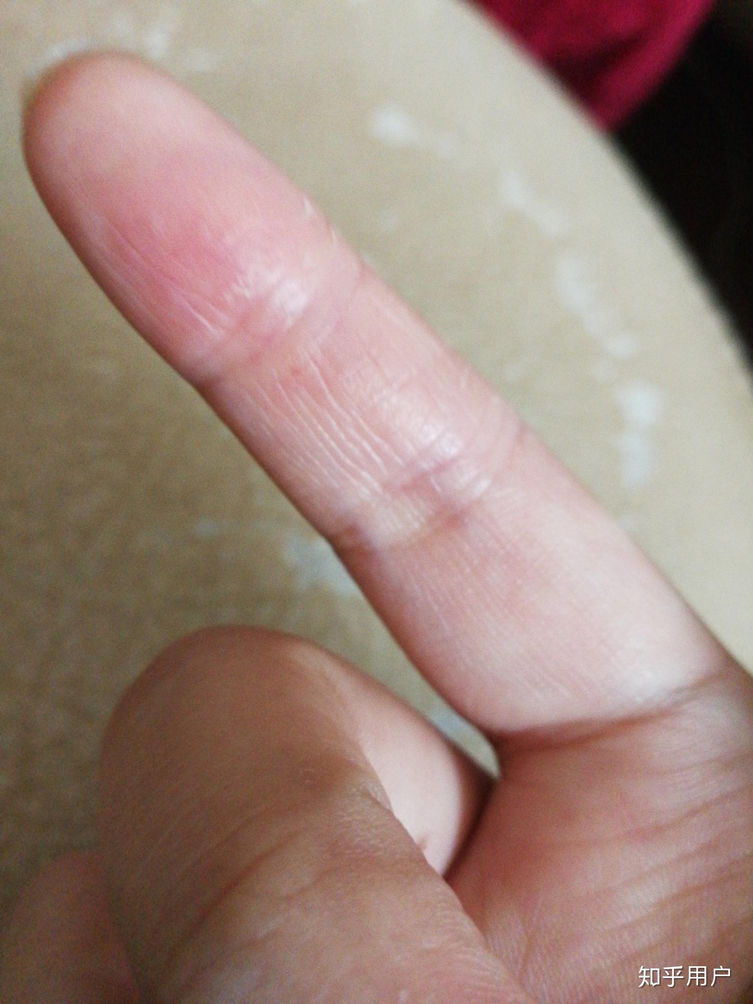 求问手指皮肤变厚变硬失去弹性然后开裂是怎么回事