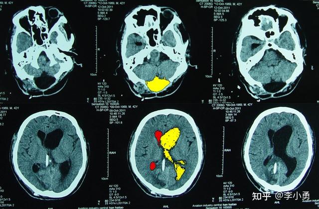 小腦扁桃體下疝脊髓空洞枕下減壓術後假性腦膜膨出腦積水手術治療失敗