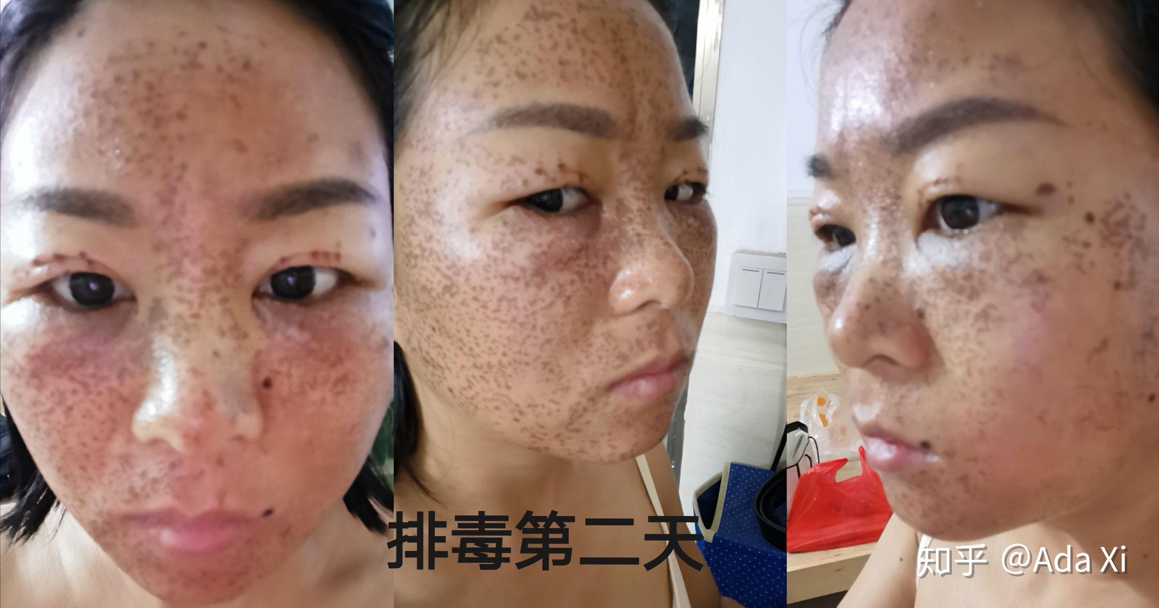 美丽的蜕变脸部排毒篇15天