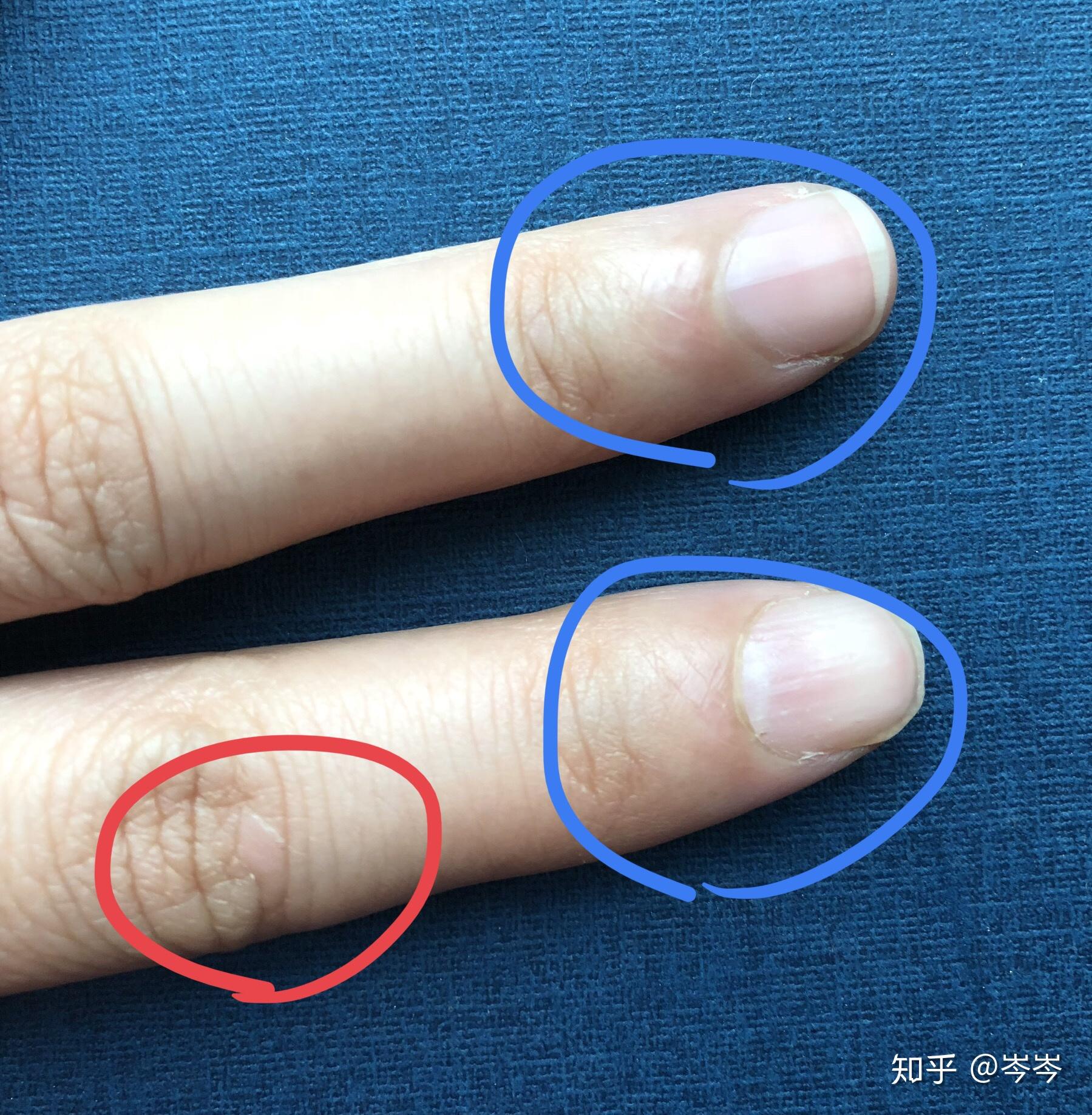 扁平疣二十多年受害者