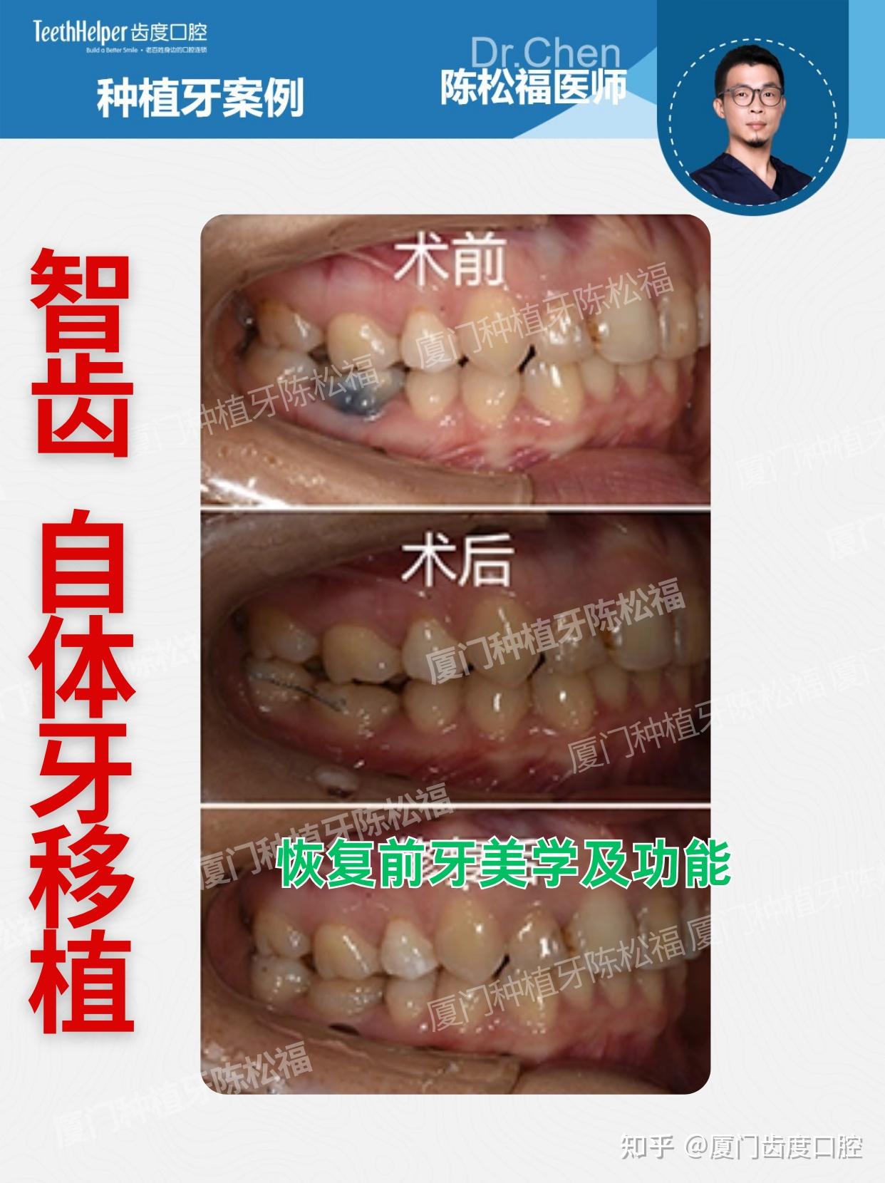 厦门自体牙移植 24岁患者根折牙获新生 - 知乎