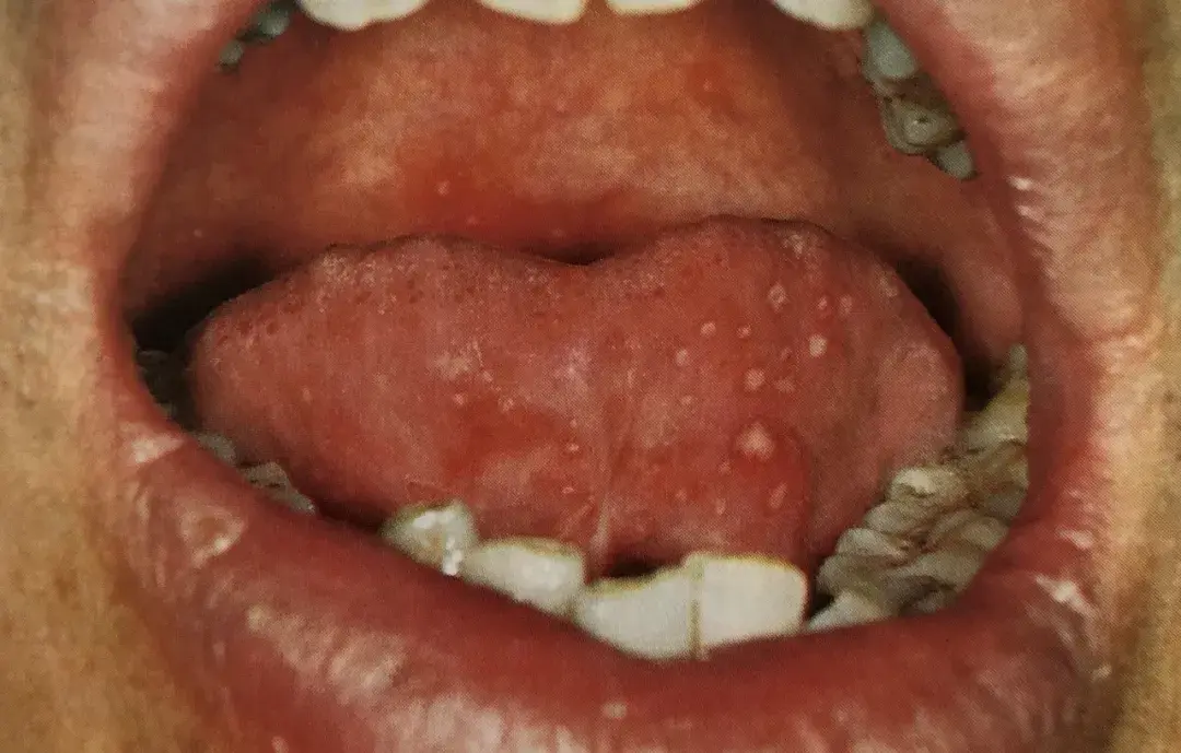 口腔溃疡种类图片图片
