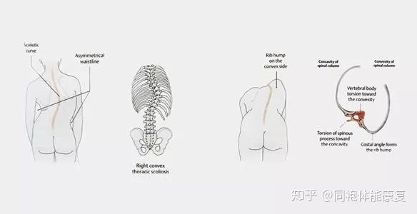 脊柱側彎不要讓弧度影響你的人生高度