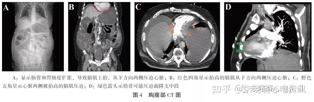 等人在非心脏危重患者的心电图中发现酷似stemi 改变, 其特征为qrs 波